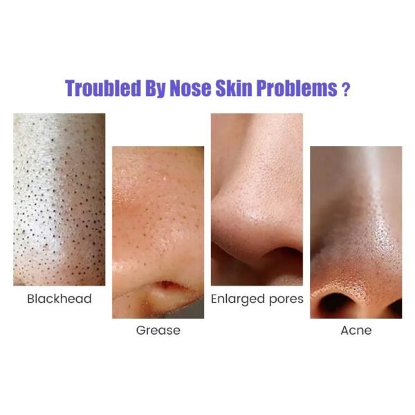 Blackhead Remover Instrument Black Dot Remover Acne Vacuum Suction Face Clean - Image 5